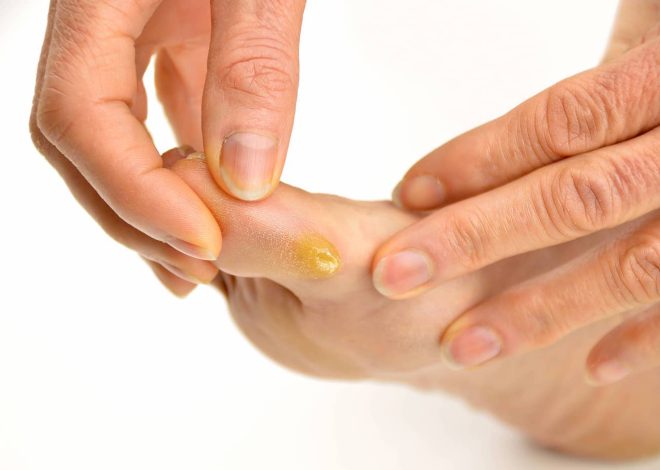 Foot Calluses: What to Do?