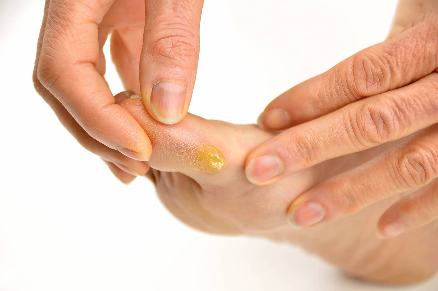 Foot Calluses: What to Do?